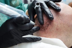 la tricopigmentation